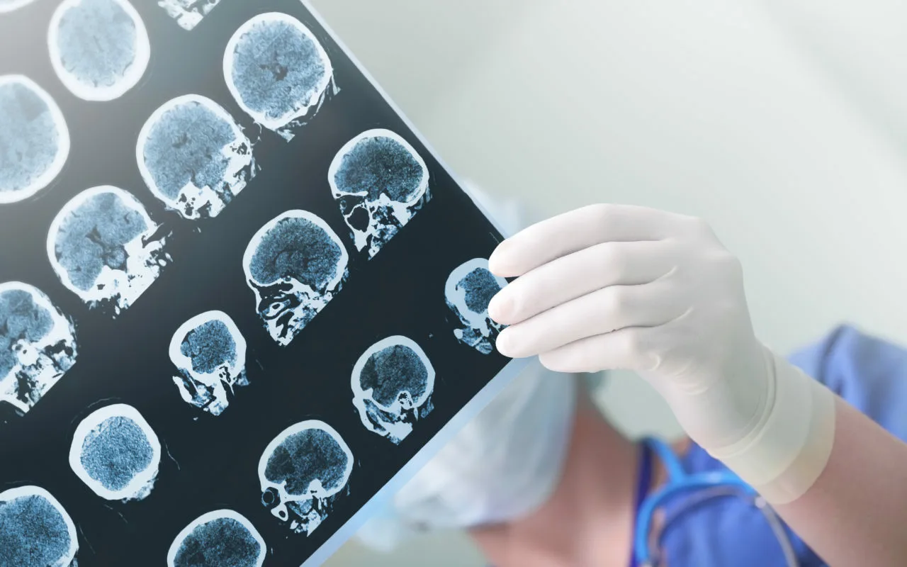 Adaptarea personalizată a biomarkerilor: o descoperire care poate schimba viitorul diagnosticării bolii Alzheimer.